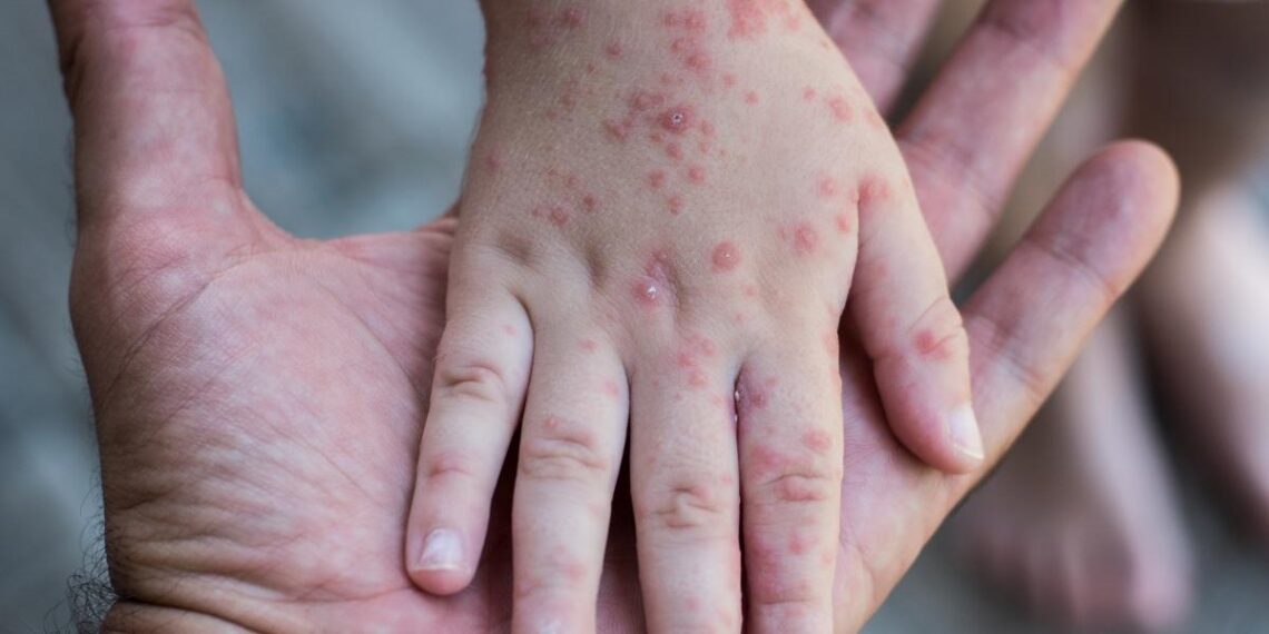 Nu får Danmark vacciner mod abekopper